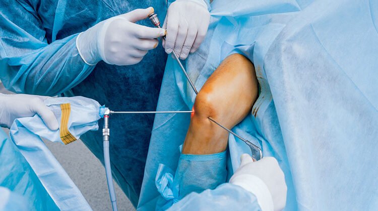  Shoulder & Knee Arthroscopy in Thane: When Is It Better Than Open Surgery